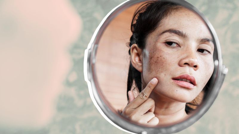What medical beauty projects should I do to lighten spots?