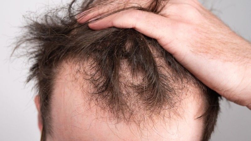 How men can avoid worsening hair loss: effective measures to prevent hair loss